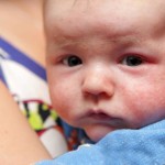 baby-with-eczema