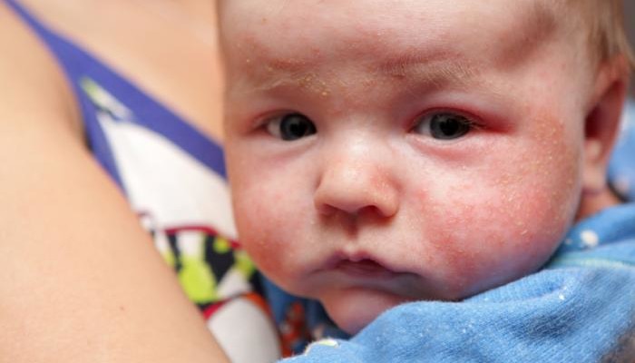 baby-with-eczema